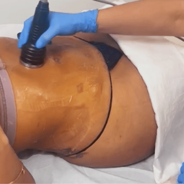 4 Post Op Lymphatic drainage at Glo'Up Body Spa in Atlanta, GA