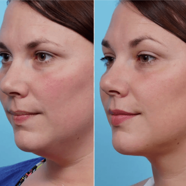 4 Double chin Simmin Treatments at Glo'Up Body Spa in Atlanta, GA